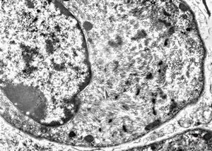 M,2m. | hypotonic syndrome - muscular atrophy